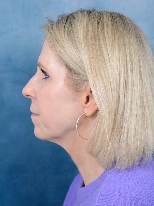 Deep Plane Facelift Before & After Gallery - Patient 41510459 - Image 5