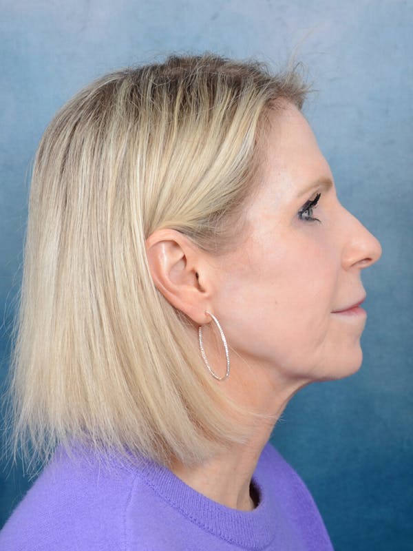 Deep Plane Facelift Before & After Gallery - Patient 41510459 - Image 9