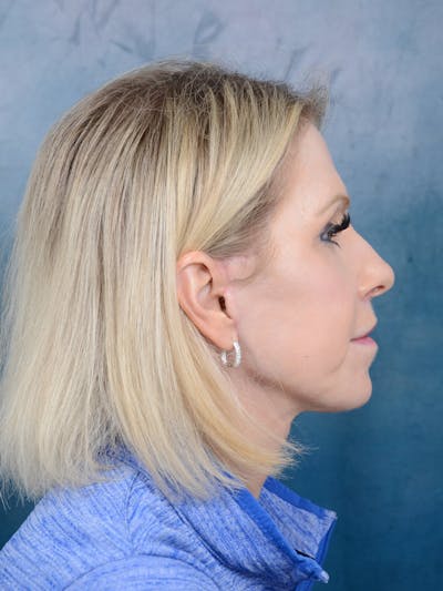 Deep Plane Facelift Before & After Gallery - Patient 41510459 - Image 10