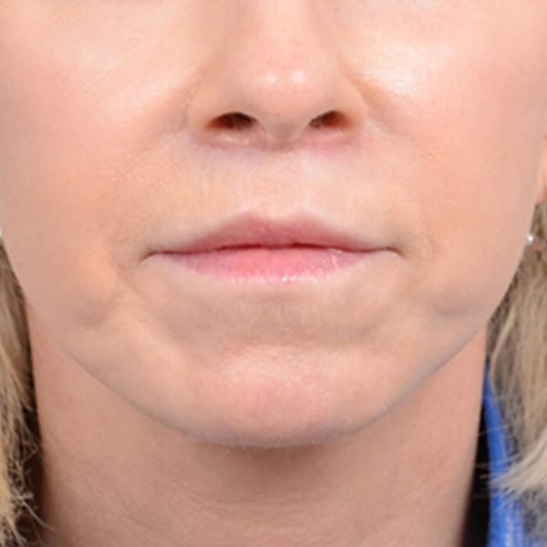 Lip Lift Before & After Gallery - Patient 41510471 - Image 2