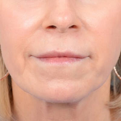 Lip Lift Before & After Gallery - Patient 41510471 - Image 1