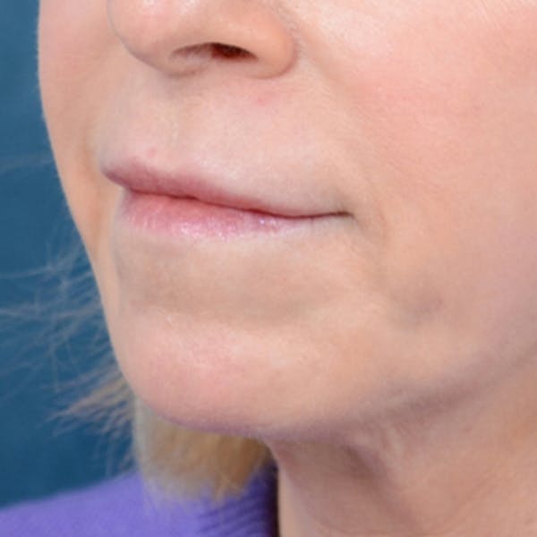 Lip Lift Before & After Gallery - Patient 41510471 - Image 3