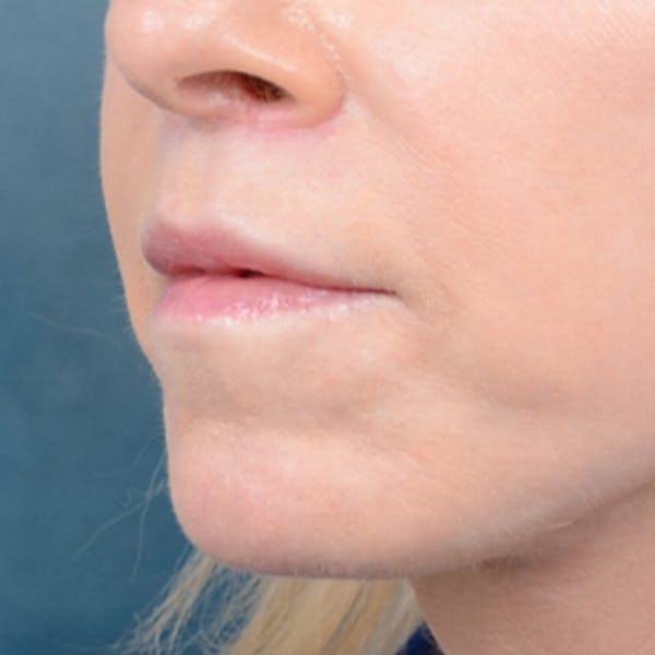 Lip Lift Before & After Gallery - Patient 41510471 - Image 4