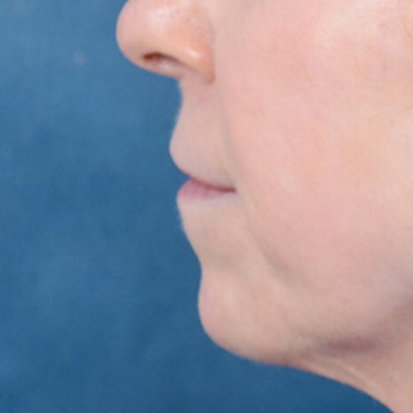 Lip Lift Before & After Gallery - Patient 41510471 - Image 5