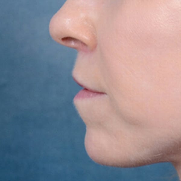 Lip Lift Before & After Gallery - Patient 41510471 - Image 6