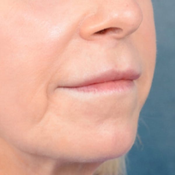 Lip Lift Before & After Gallery - Patient 41510471 - Image 7