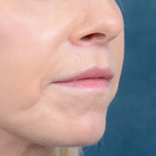 Lip Lift Before & After Gallery - Patient 41510471 - Image 8