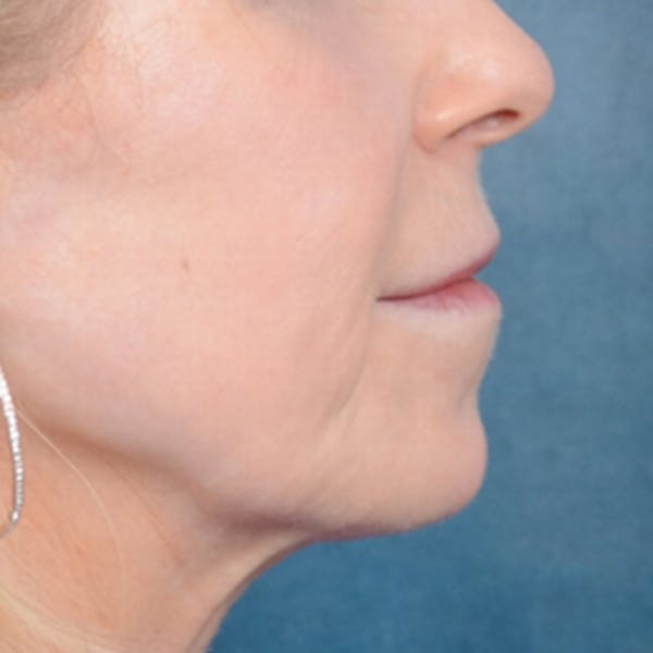 Lip Lift Before & After Gallery - Patient 41510471 - Image 9