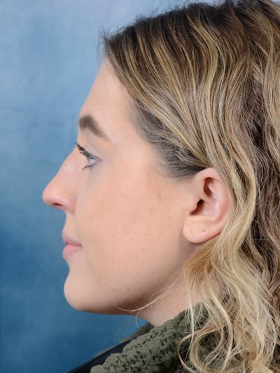 Rhinoplasty Before & After Gallery - Patient 42744213 - Image 1