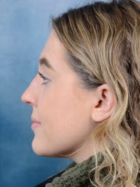 Rhinoplasty Before & After Gallery - Patient 42744213 - Image 1