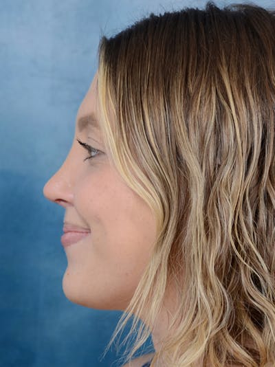 Rhinoplasty Before & After Gallery - Patient 42744213 - Image 2