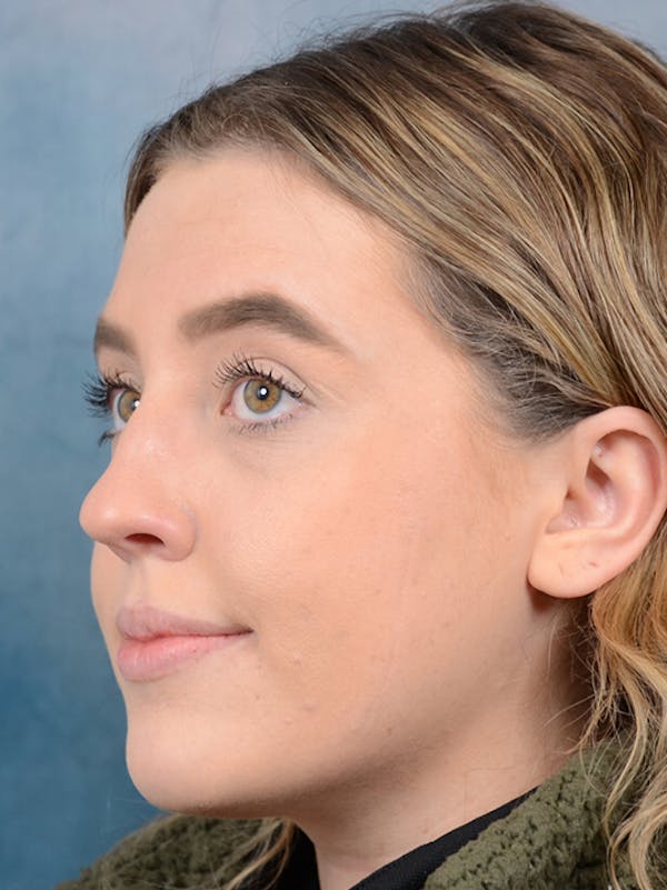 Rhinoplasty Before & After Gallery - Patient 42744213 - Image 5