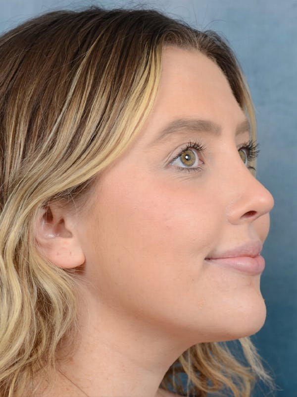 Rhinoplasty Before & After Gallery - Patient 42744213 - Image 8