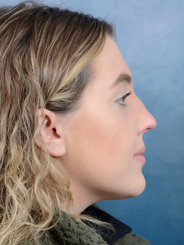 Rhinoplasty Before & After Gallery - Patient 42744213 - Image 9