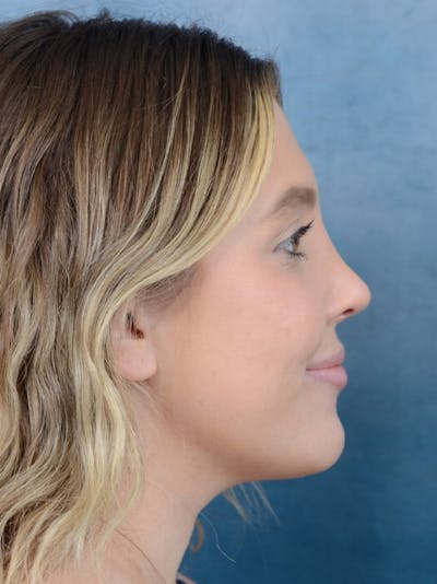 Rhinoplasty Before & After Gallery - Patient 42744213 - Image 10