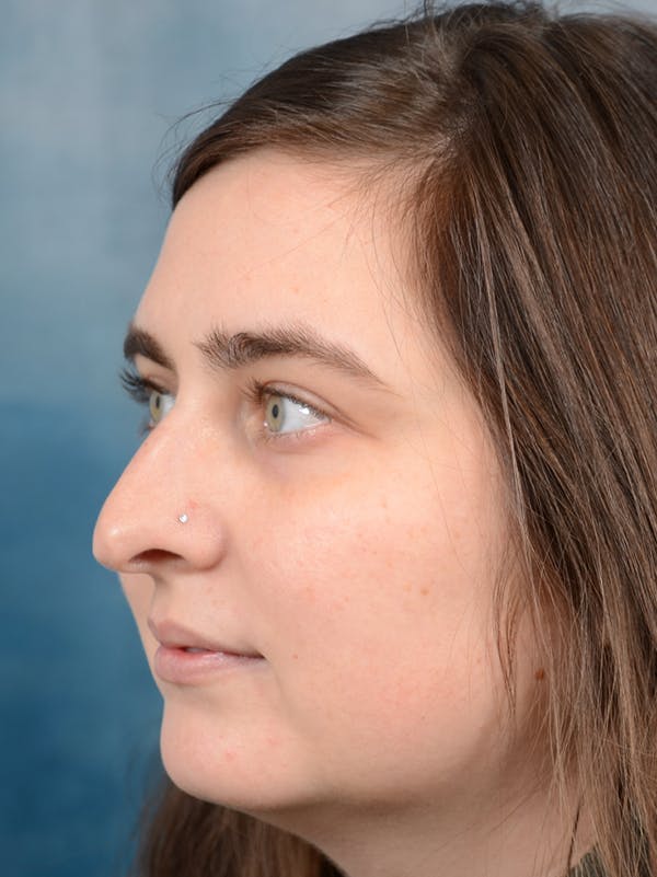 Rhinoplasty Gallery - Patient 44232963 - Image 3