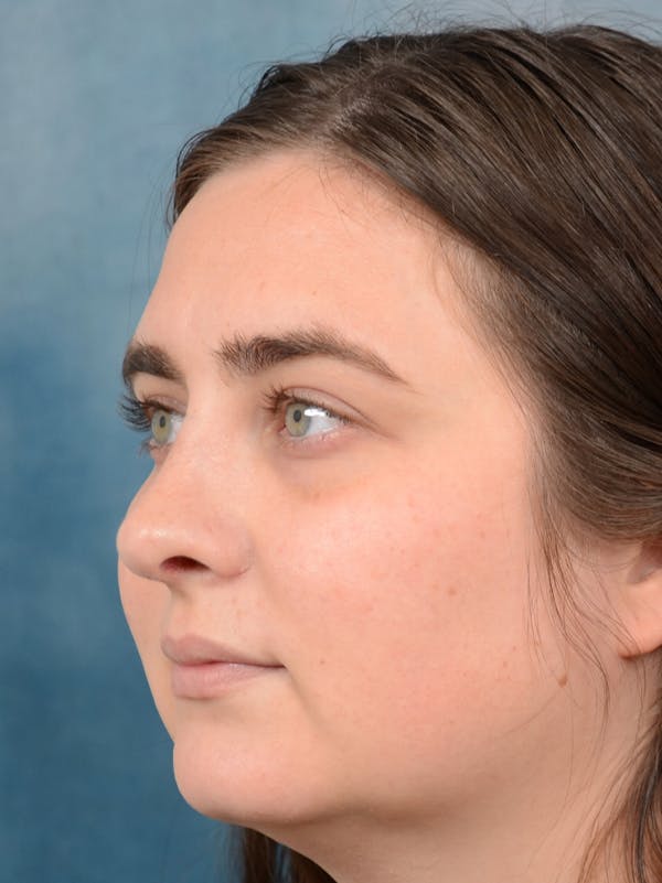 Rhinoplasty Gallery - Patient 44232963 - Image 4