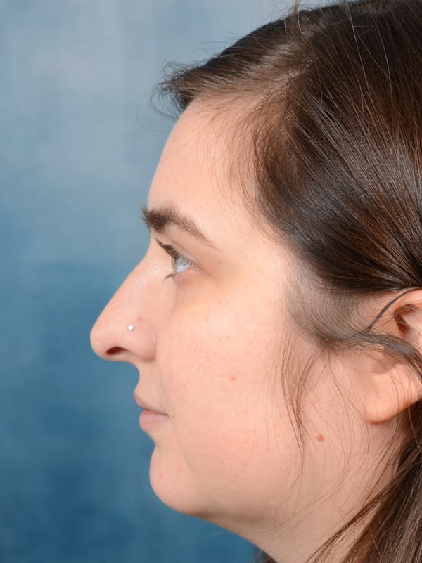 Rhinoplasty Gallery - Patient 44232963 - Image 5