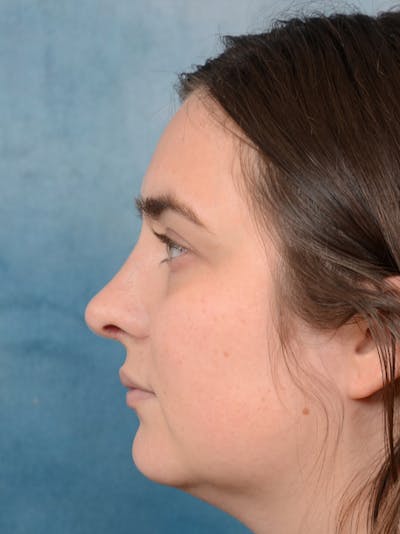 Rhinoplasty Gallery - Patient 44232963 - Image 6