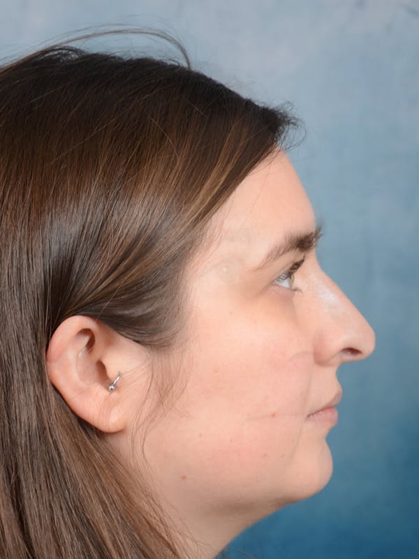 Rhinoplasty Gallery - Patient 44232963 - Image 9