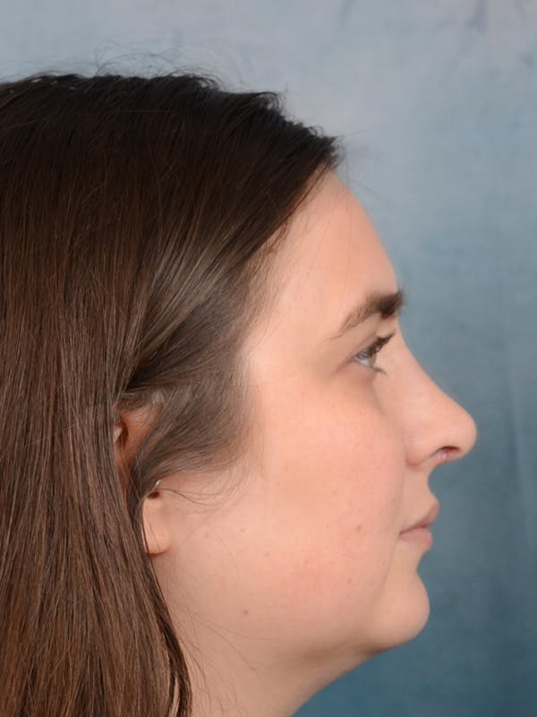 Rhinoplasty Gallery - Patient 44232963 - Image 10