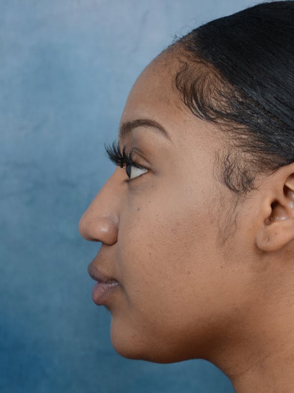 Rhinoplasty Before & After Gallery - Patient 44233111 - Image 1
