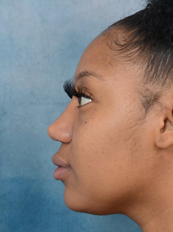 Rhinoplasty Before & After Gallery - Patient 44233111 - Image 2