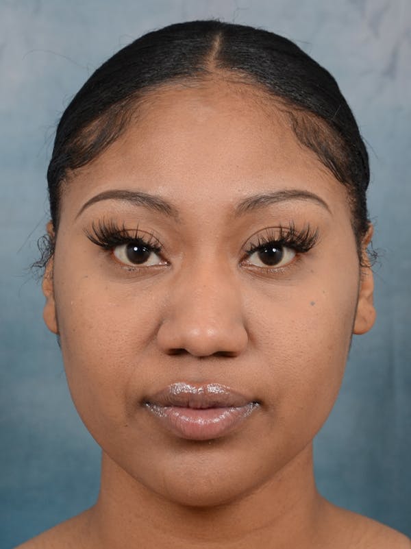 Rhinoplasty Before & After Gallery - Patient 44233111 - Image 3