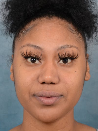 Rhinoplasty Before & After Gallery - Patient 44233111 - Image 4