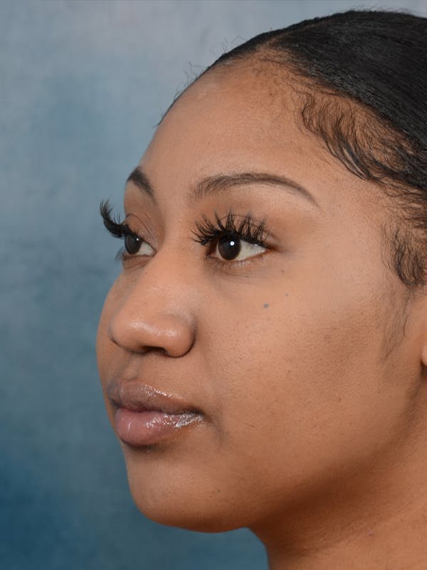 Rhinoplasty Before & After Gallery - Patient 44233111 - Image 5