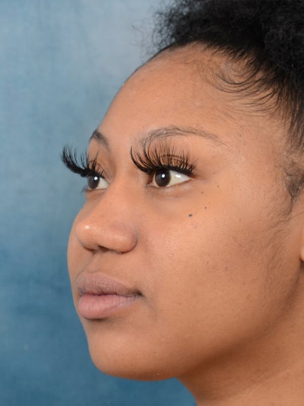 Rhinoplasty Before & After Gallery - Patient 44233111 - Image 6