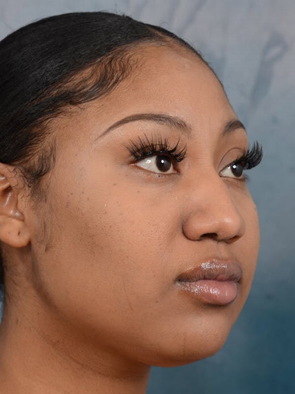 Rhinoplasty Before & After Gallery - Patient 44233111 - Image 7