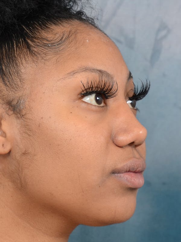 Rhinoplasty Before & After Gallery - Patient 44233111 - Image 8