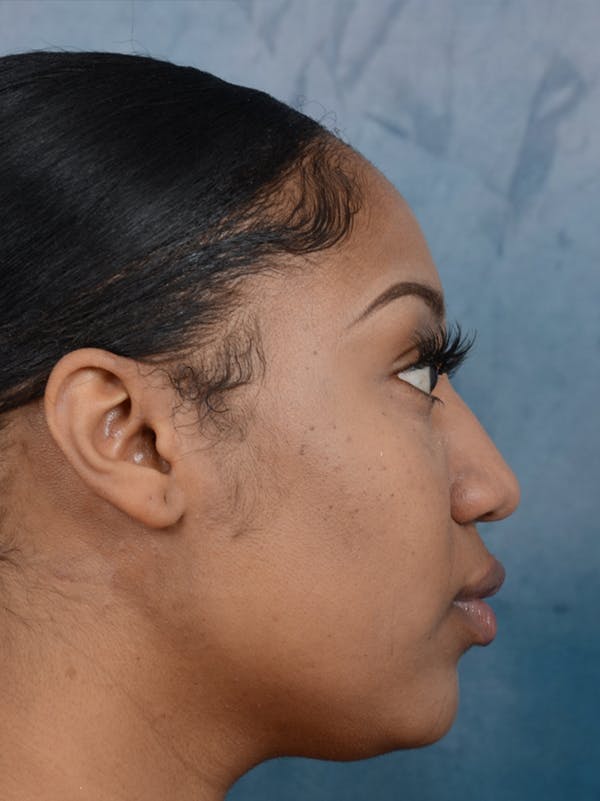 Rhinoplasty Before & After Gallery - Patient 44233111 - Image 9