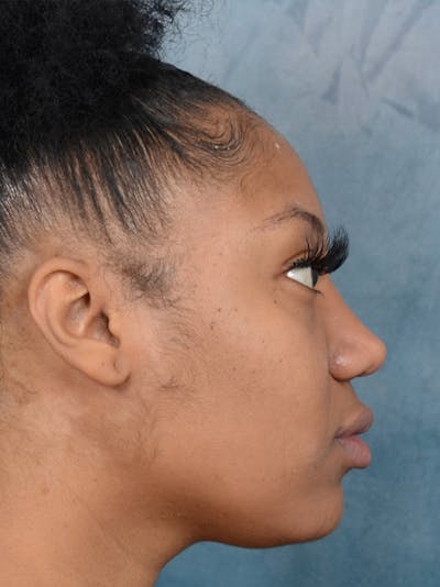 Rhinoplasty Before & After Gallery - Patient 44233111 - Image 10