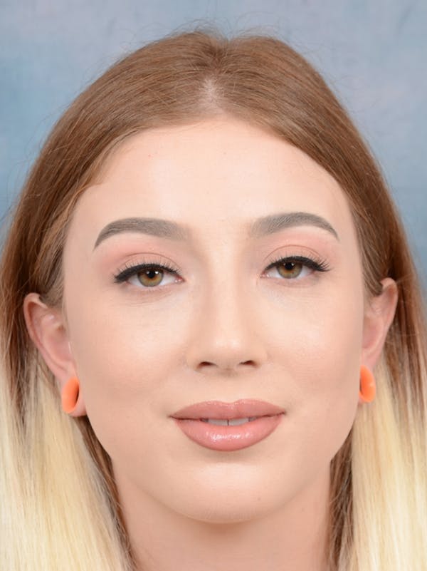 Rhinoplasty Gallery - Patient 44329923 - Image 2