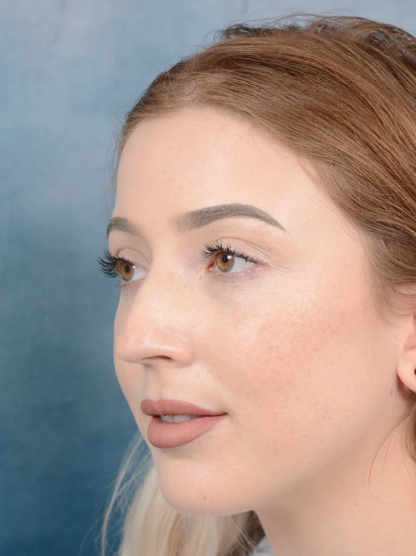 Rhinoplasty Gallery - Patient 44329923 - Image 3