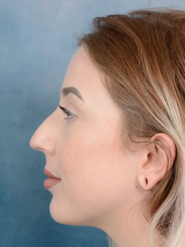 Rhinoplasty Gallery - Patient 44329923 - Image 5