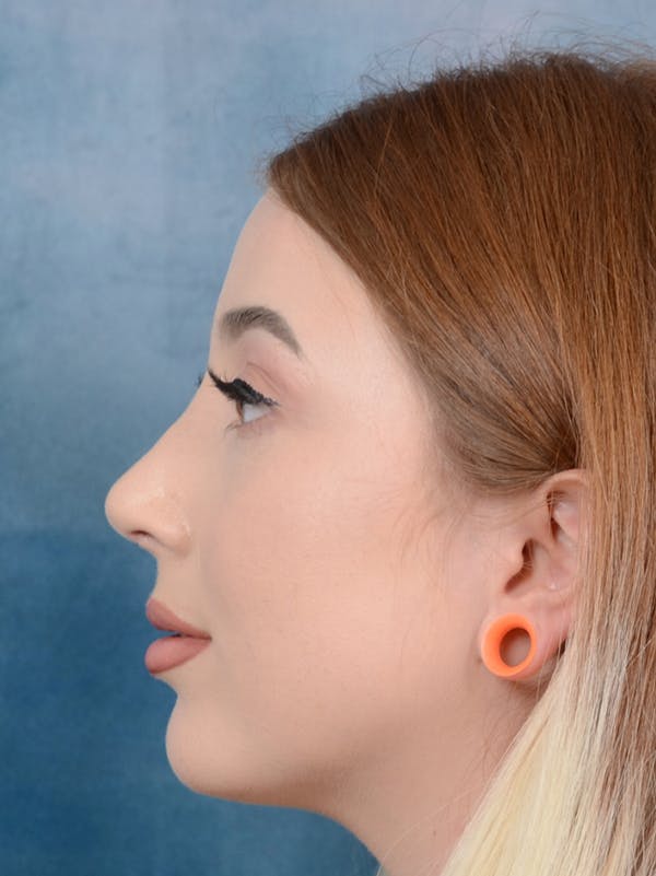 Rhinoplasty Gallery - Patient 44329923 - Image 6