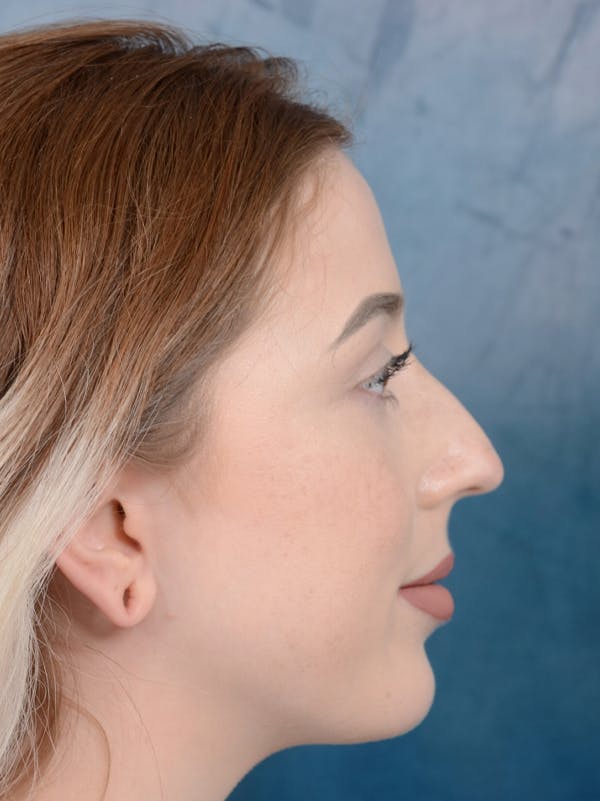 Rhinoplasty Gallery - Patient 44329923 - Image 9