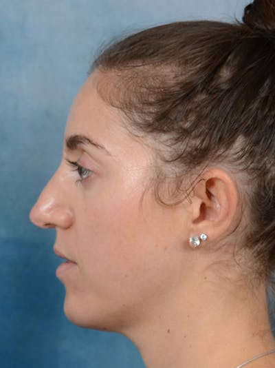 Revision Rhinoplasty Before