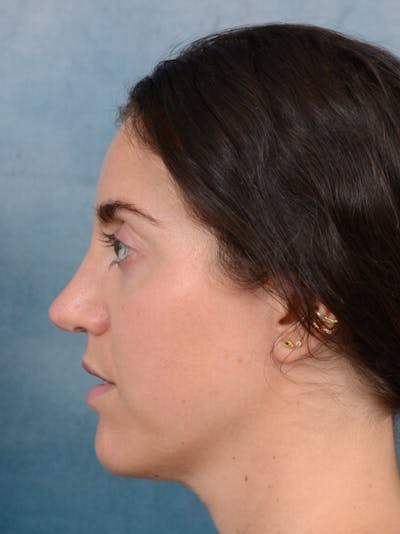 Revision Rhinoplasty After