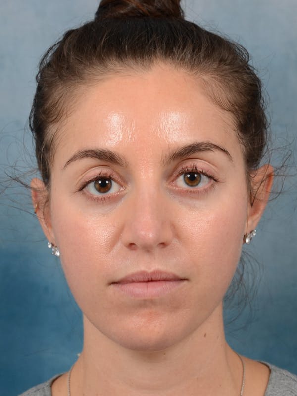 Revision Rhinoplasty Before & After Gallery - Patient 66235036 - Image 3