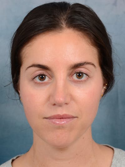 Revision Rhinoplasty Before & After Gallery - Patient 66235036 - Image 4