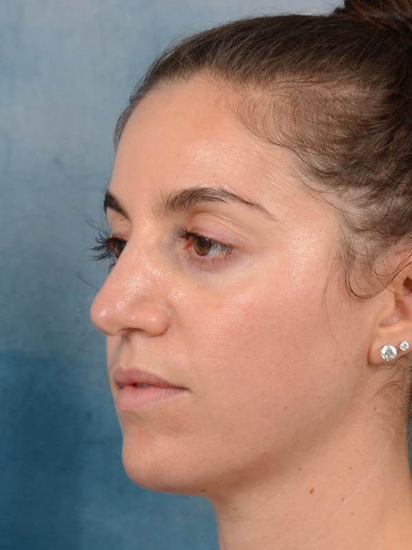 Revision Rhinoplasty Before & After Gallery - Patient 66235036 - Image 5