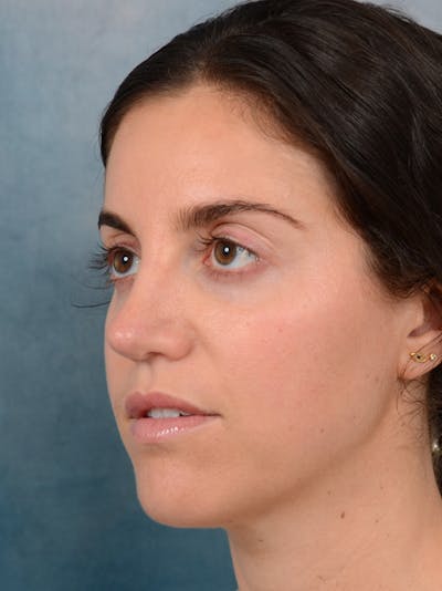 Revision Rhinoplasty Before & After Gallery - Patient 66235036 - Image 6