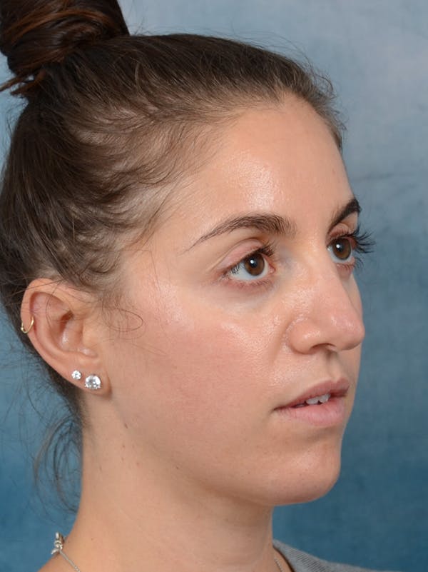 Revision Rhinoplasty Before & After Gallery - Patient 66235036 - Image 7