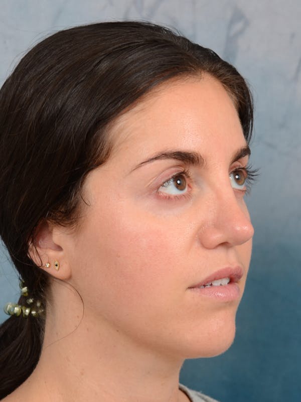 Revision Rhinoplasty Before & After Gallery - Patient 66235036 - Image 8