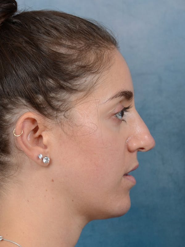 Revision Rhinoplasty Gallery - Patient 66235036 - Image 9