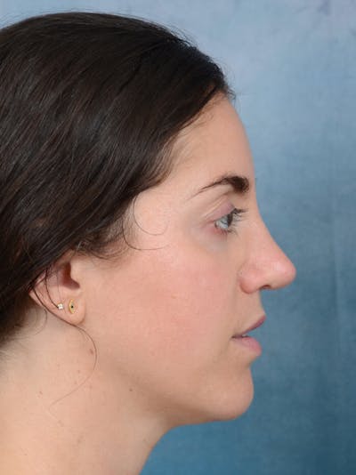 Revision Rhinoplasty Before & After Gallery - Patient 66235036 - Image 10